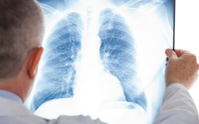Nódulo no pulmão pode ser câncer?